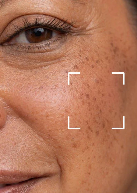 Dark Spot & Pigmentation