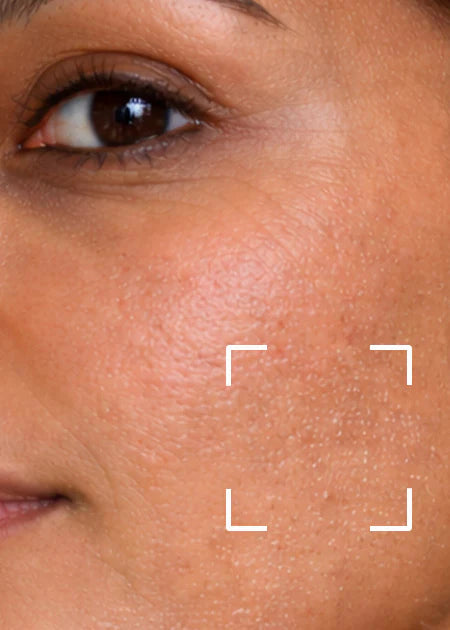 Dry to very dry skin