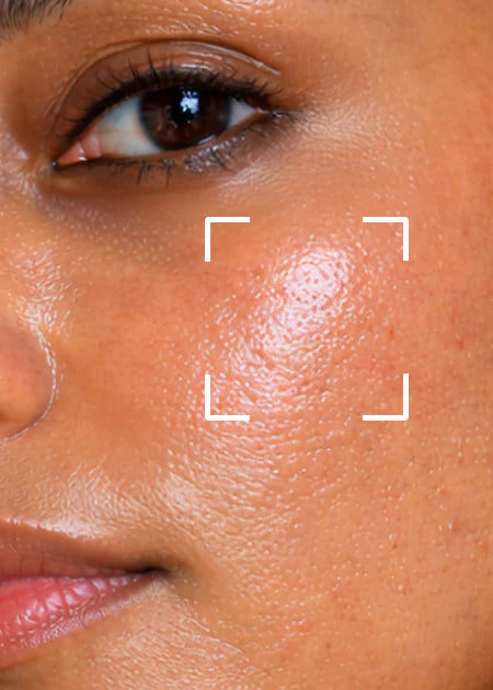 Oily & Acne Skin