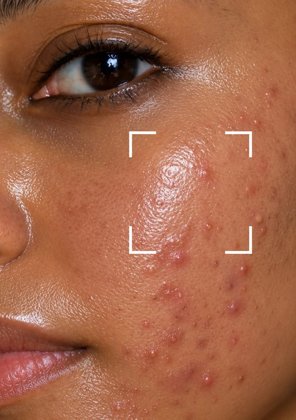 Oily & Acne Skin